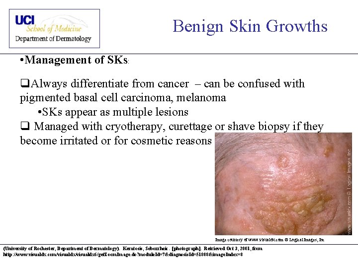 Benign Skin Growths • Management of SKs: q. Always differentiate from cancer – can