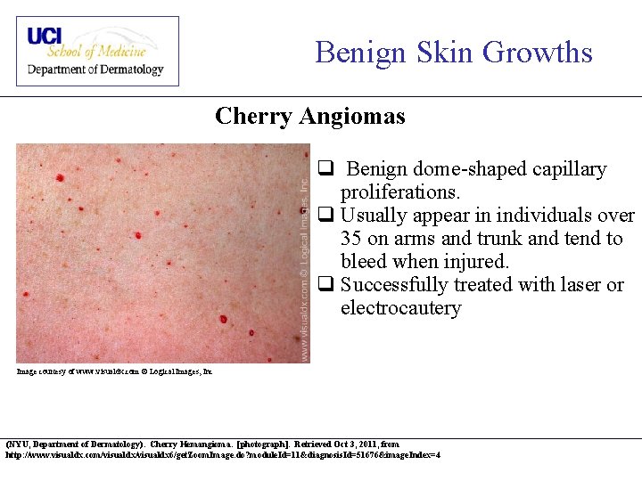 Benign Skin Growths Cherry Angiomas q Benign dome-shaped capillary proliferations. q Usually appear in