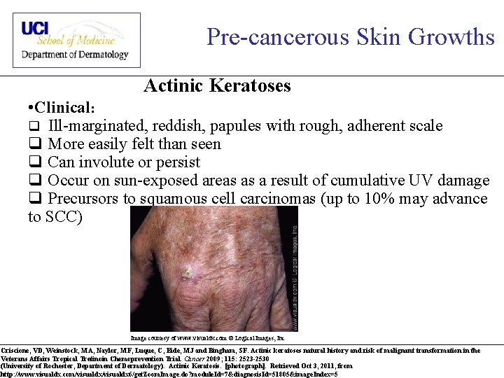 Pre-cancerous Skin Growths Actinic Keratoses • Clinical: q Ill-marginated, reddish, papules with rough, adherent