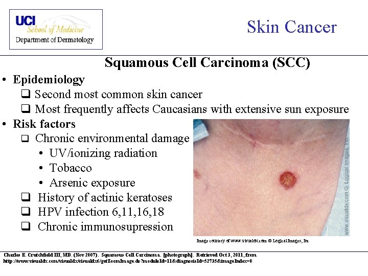 Skin Cancer Squamous Cell Carcinoma (SCC) • Epidemiology q Second most common skin cancer