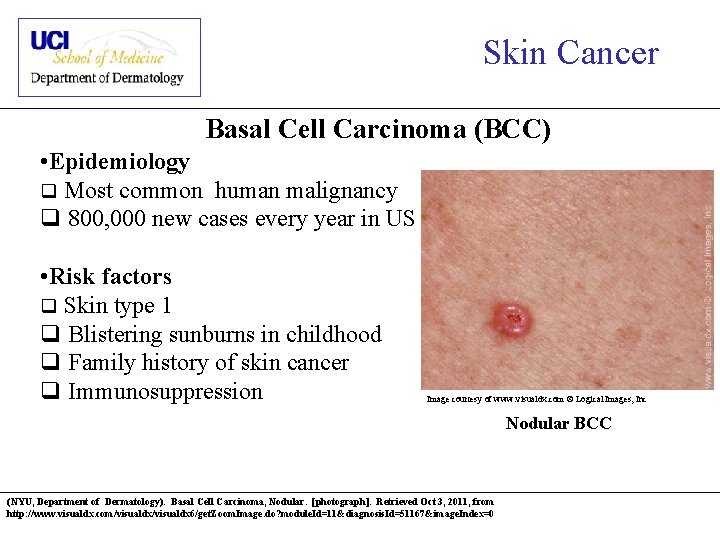 Skin Cancer Basal Cell Carcinoma (BCC) • Epidemiology q Most common human malignancy q