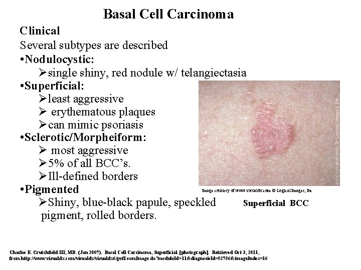 Basal Cell Carcinoma Clinical Several subtypes are described • Nodulocystic: Øsingle shiny, red nodule
