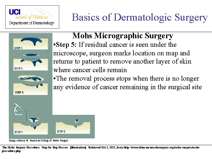 Basics of Dermatologic Surgery Mohs Micrographic Surgery • Step 5: If residual cancer is