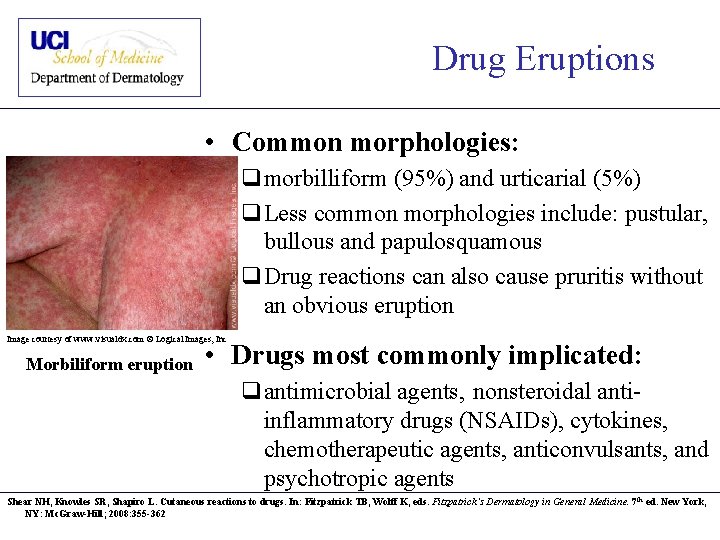 Drug Eruptions • Common morphologies: qmorbilliform (95%) and urticarial (5%) q. Less common morphologies