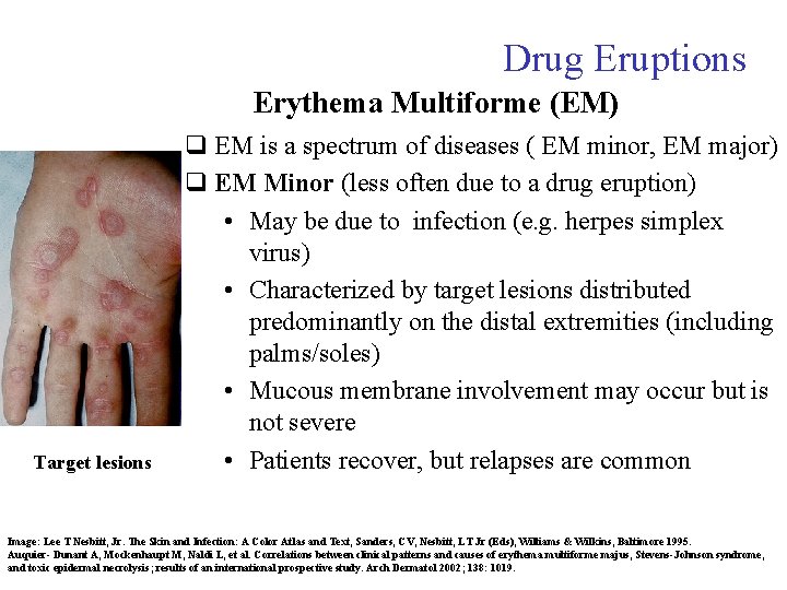 Drug Eruptions Erythema Multiforme (EM) Target lesions q EM is a spectrum of diseases