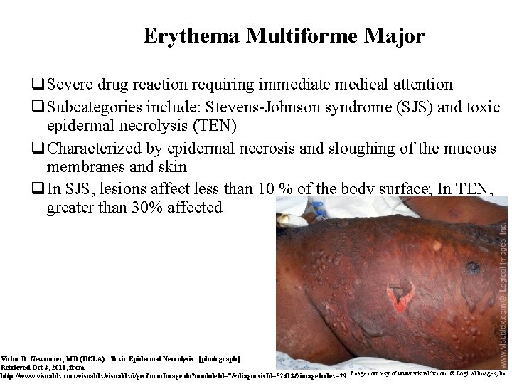 Erythema Multiforme Major q. Severe drug reaction requiring immediate medical attention q. Subcategories include: