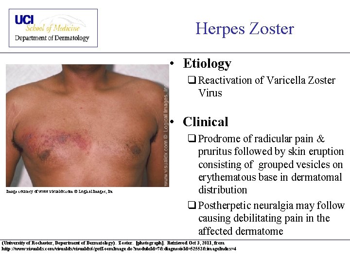 Herpes Zoster • Etiology q Reactivation of Varicella Zoster Virus • Clinical Image courtesy