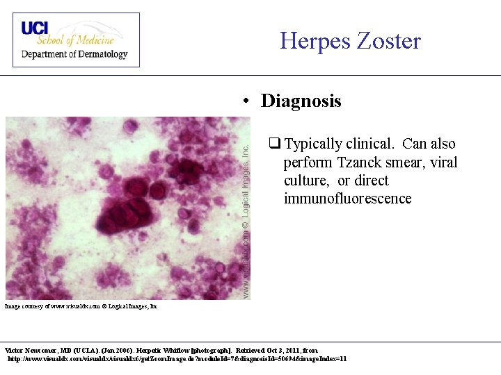 Herpes Zoster • Diagnosis q Typically clinical. Can also perform Tzanck smear, viral culture,