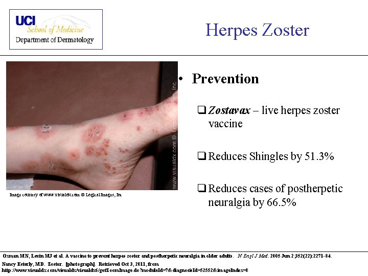 Herpes Zoster • Prevention q Zostavax – live herpes zoster vaccine q Reduces Shingles