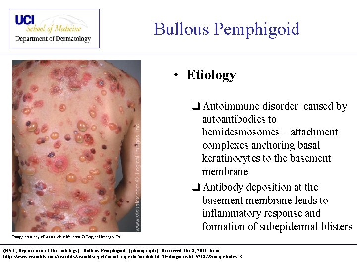 Bullous Pemphigoid • Etiology q Autoimmune disorder caused by autoantibodies to hemidesmosomes – attachment