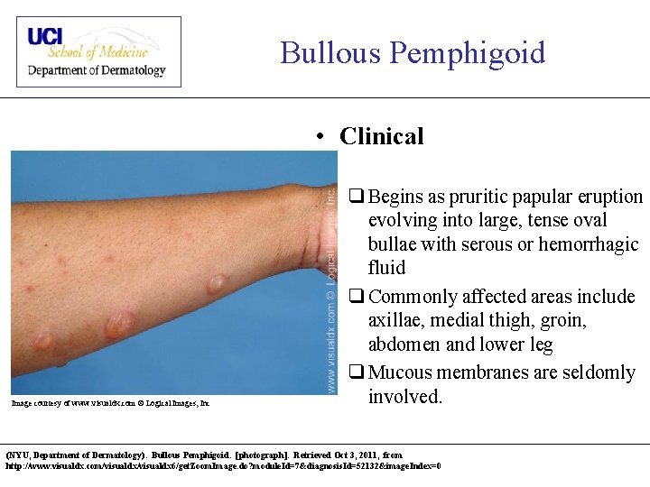 Bullous Pemphigoid • Clinical Image courtesy of www. visualdx. com © Logical Images, Inc