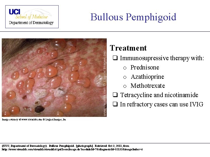 Bullous Pemphigoid • Treatment q Immunosupressive therapy with: o Prednisone o Azathioprine o Methotrexate