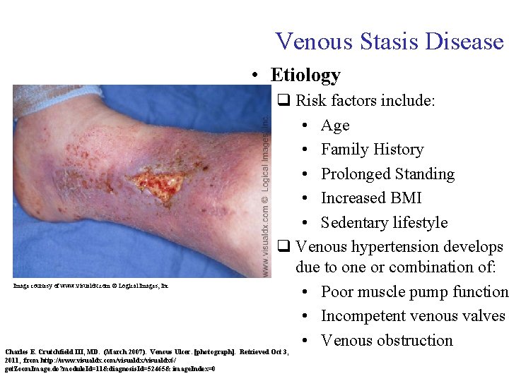 Venous Stasis Disease • Etiology q Risk factors include: • Age • Family History