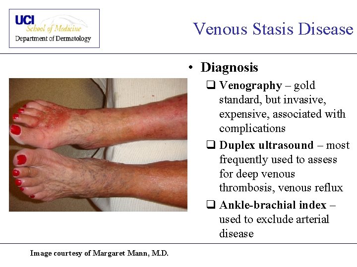 Venous Stasis Disease • Diagnosis q Venography – gold standard, but invasive, expensive, associated