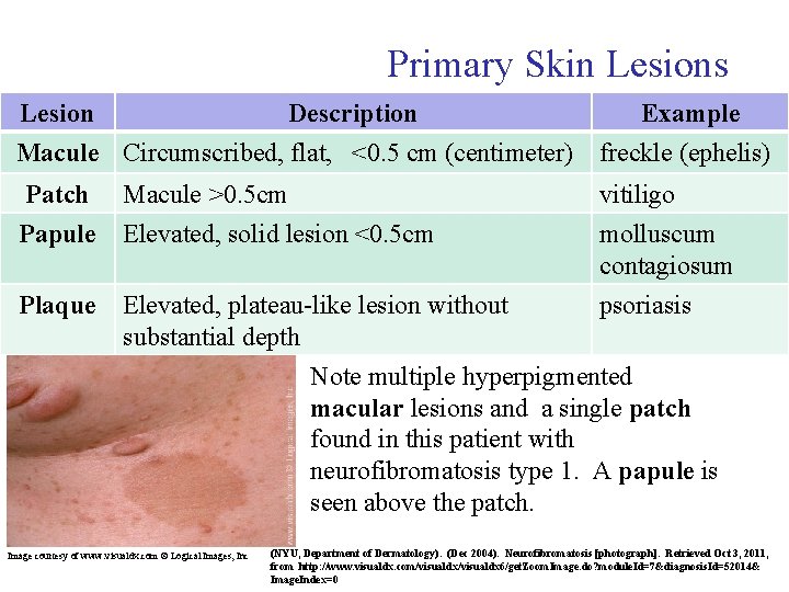 Primary Skin Lesions Lesion Description Example Macule Circumscribed, flat, <0. 5 cm (centimeter) freckle