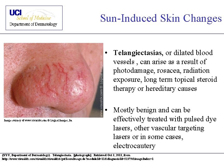 Sun-Induced Skin Changes • Telangiectasias, or dilated blood vessels , can arise as a