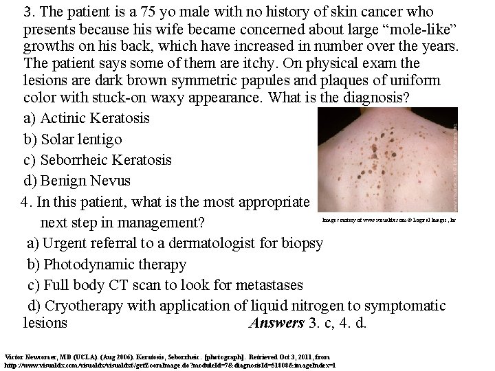 3. The patient is a 75 yo male with no history of skin cancer