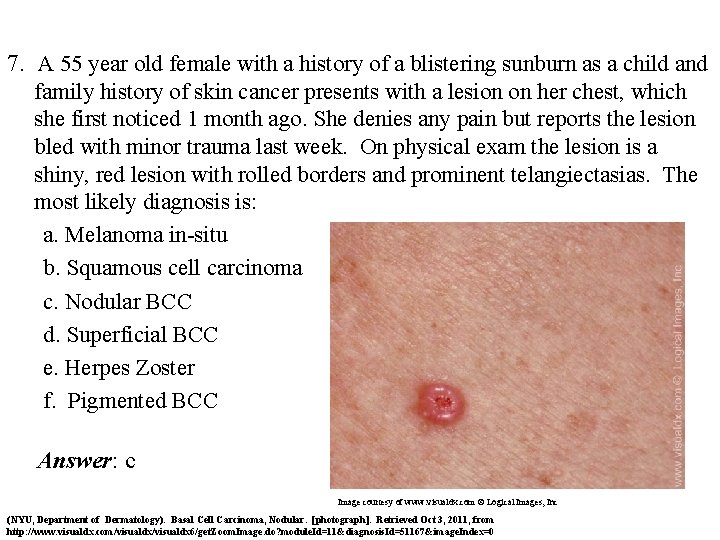 7. A 55 year old female with a history of a blistering sunburn as
