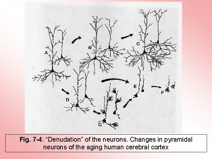 Fig. 7 -4: “Denudation” of the neurons. Changes in pyramidal neurons of the aging