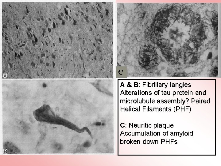 C A & B: Fibrillary tangles Alterations of tau protein and microtubule assembly? Paired