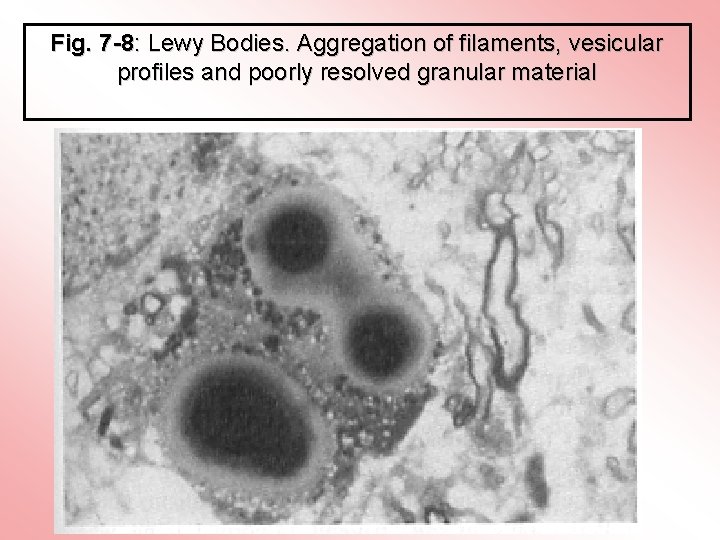 Fig. 7 -8: Lewy Bodies. Aggregation of filaments, vesicular profiles and poorly resolved granular