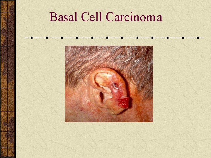 Basal Cell Carcinoma 