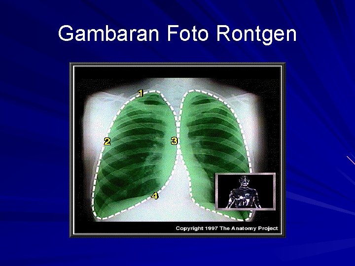 Gambaran Foto Rontgen Gambaran Foto Rontgen