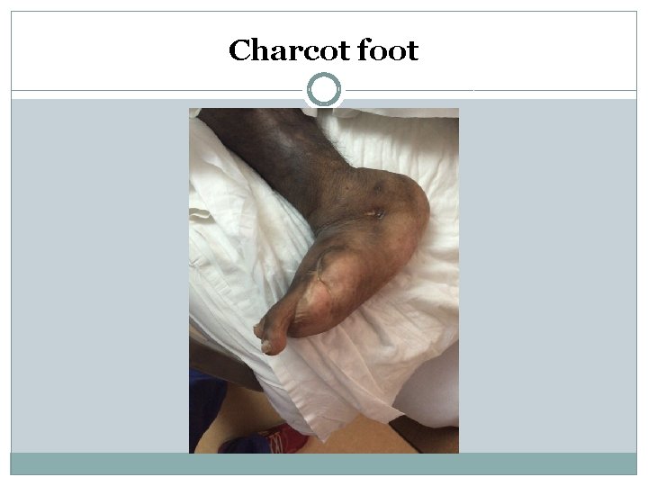 Charcot foot 