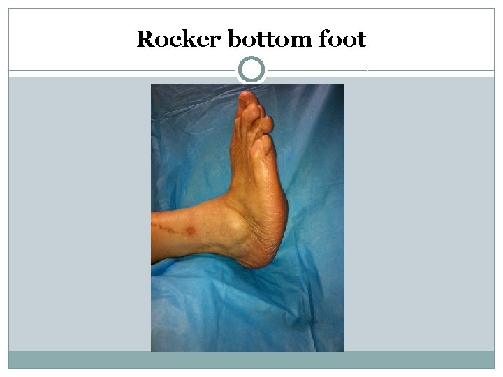 Rocker bottom foot 