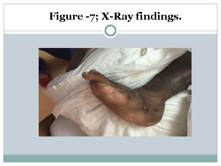Figure -7; X-Ray findings. 