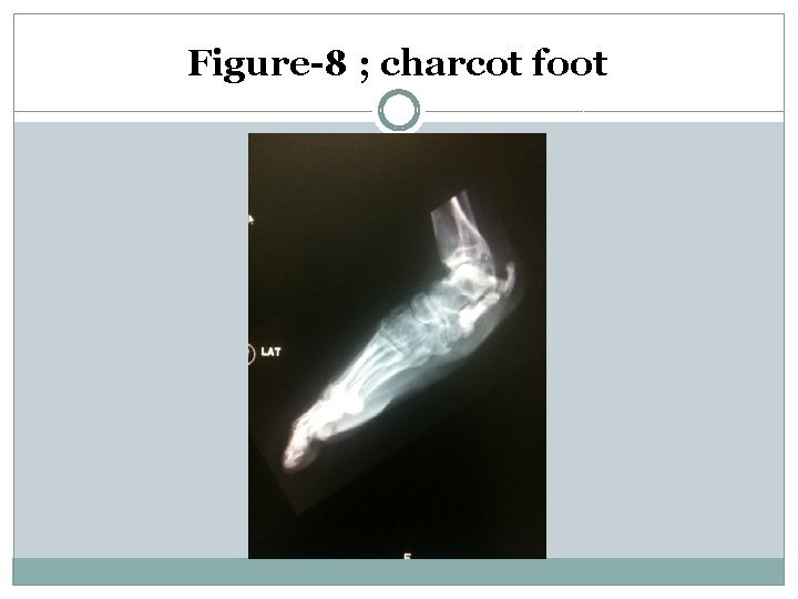 Figure-8 ; charcot foot 