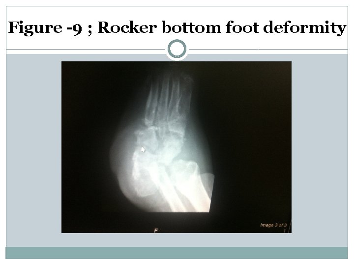 Figure -9 ; Rocker bottom foot deformity 