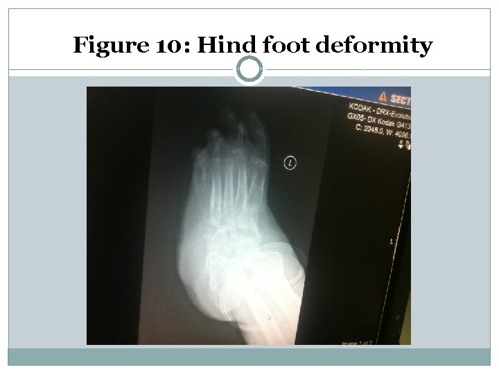 Figure 10: Hind foot deformity 