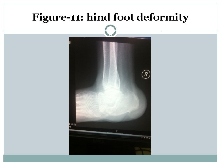 Figure-11: hind foot deformity 