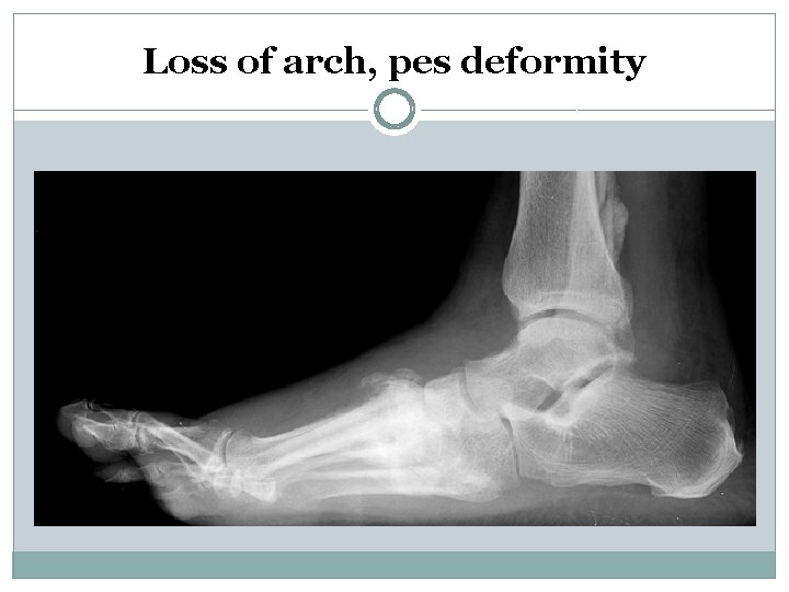 Loss of arch, pes deformity 