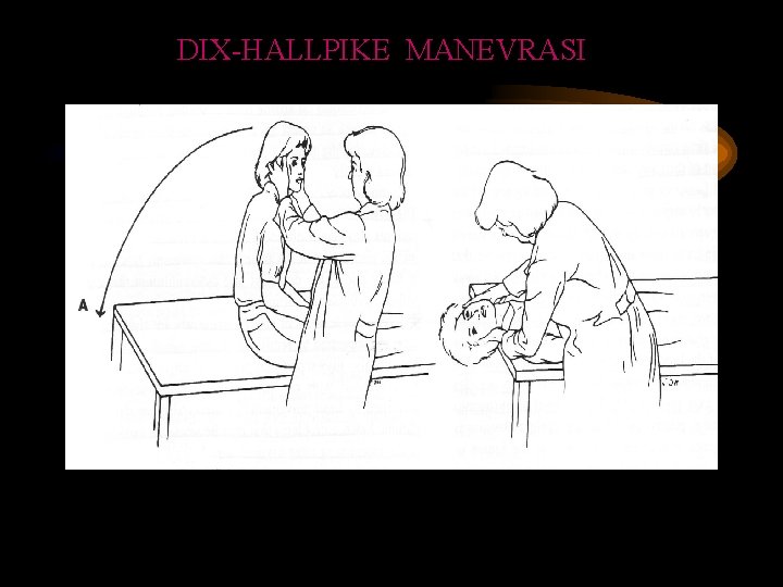 DIX-HALLPIKE MANEVRASI 