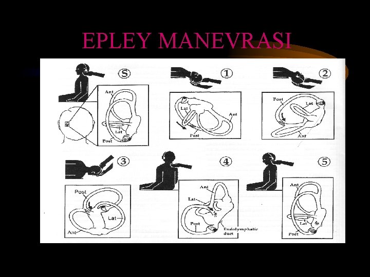 EPLEY MANEVRASI 