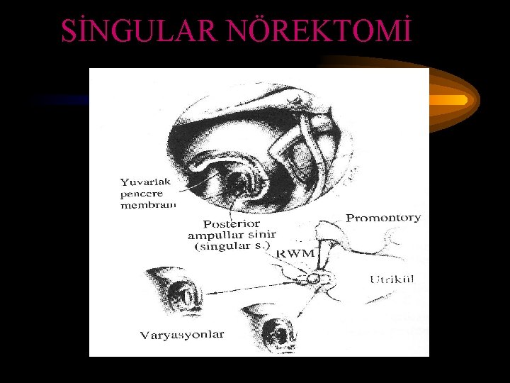 SİNGULAR NÖREKTOMİ 