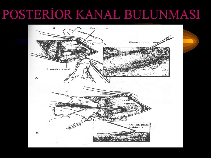 POSTERİOR KANAL BULUNMASI 