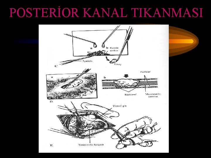 POSTERİOR KANAL TIKANMASI 