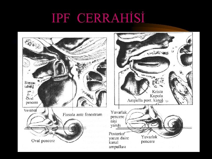 IPF CERRAHİSİ 