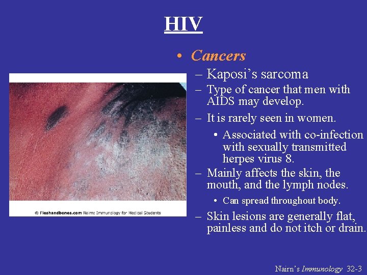 HIV • Cancers – Kaposi’s sarcoma – Type of cancer that men with AIDS