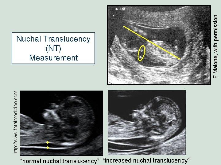 http: //www. fetalmedicine. com “normal nuchal translucency” “increased nuchal translucency” F Malone, with permission http: //www. fetalmedicine. com “normal nuchal translucency” “increased nuchal translucency” F Malone, with permission
