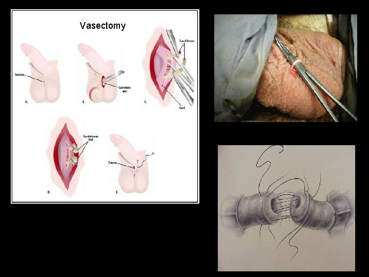 Vasectomy 