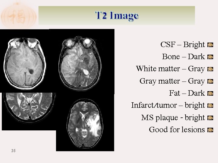 T 2 Image Infarct Tumor 35 CSF – Bright Bone – Dark White matter