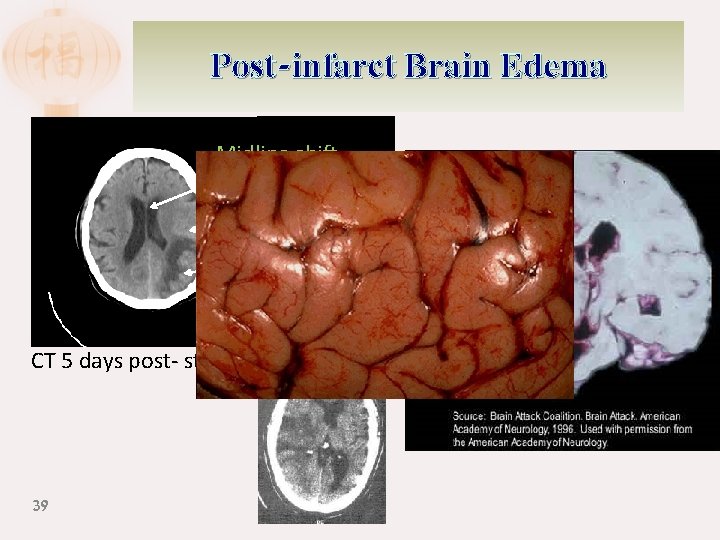 Post-infarct Brain Edema Midline shift Sulci abolished Pressure on neighboring structures CT 5 days