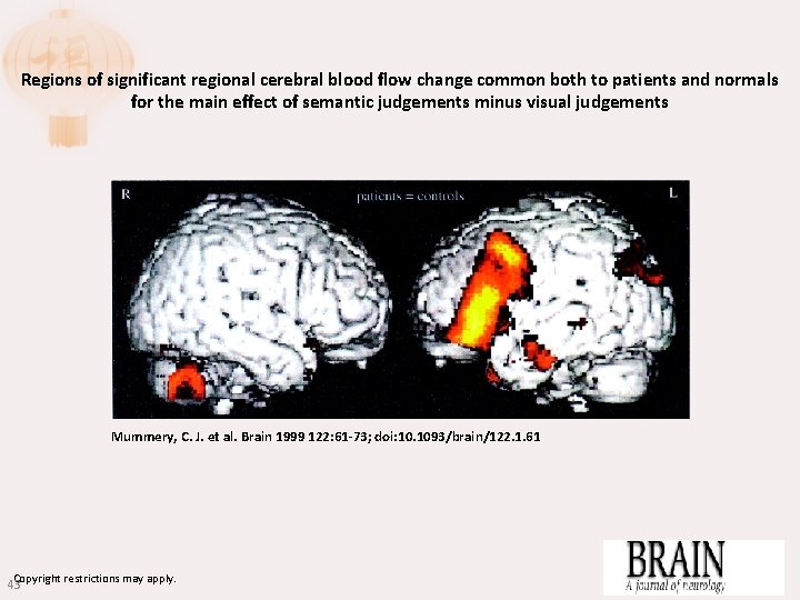 Regions of significant regional cerebral blood flow change common both to patients and normals