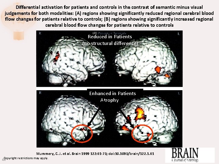 Differential activation for patients and controls in the contrast of semantic minus visual judgements