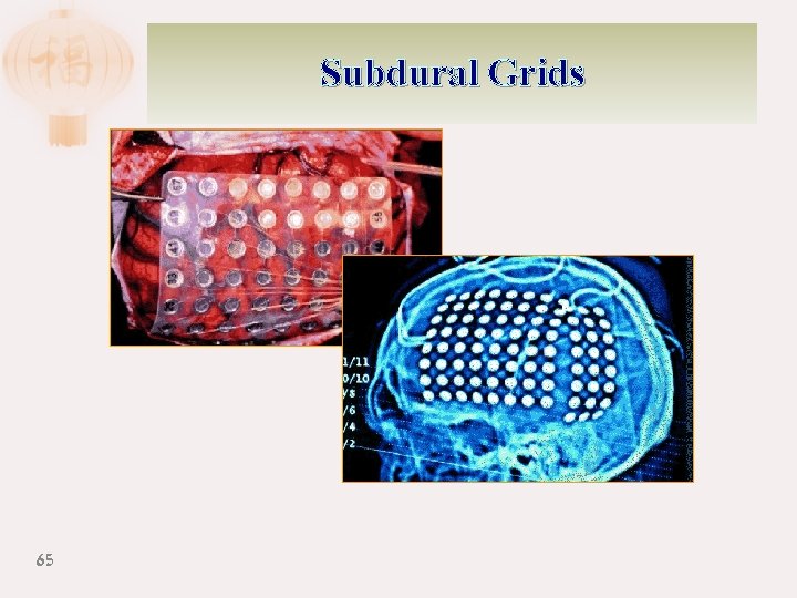 Subdural Grids 65 