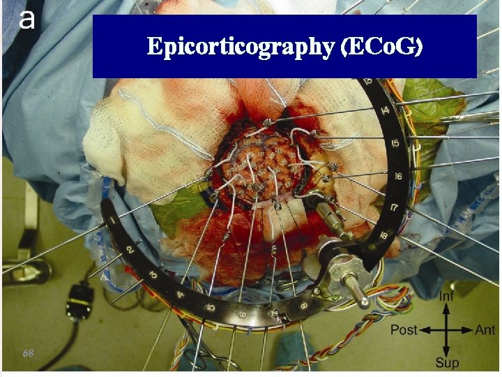 Epicorticography (ECo. G) 68 